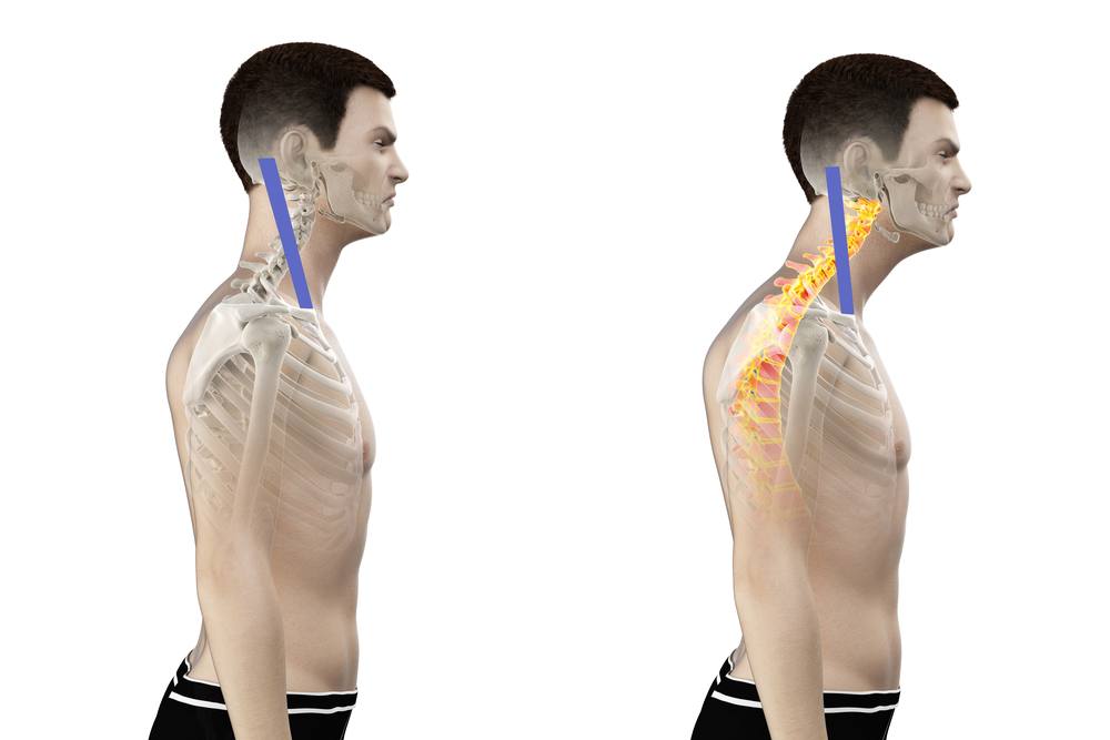 Sternocleidomastoideus a předsunuté držení hlavy
