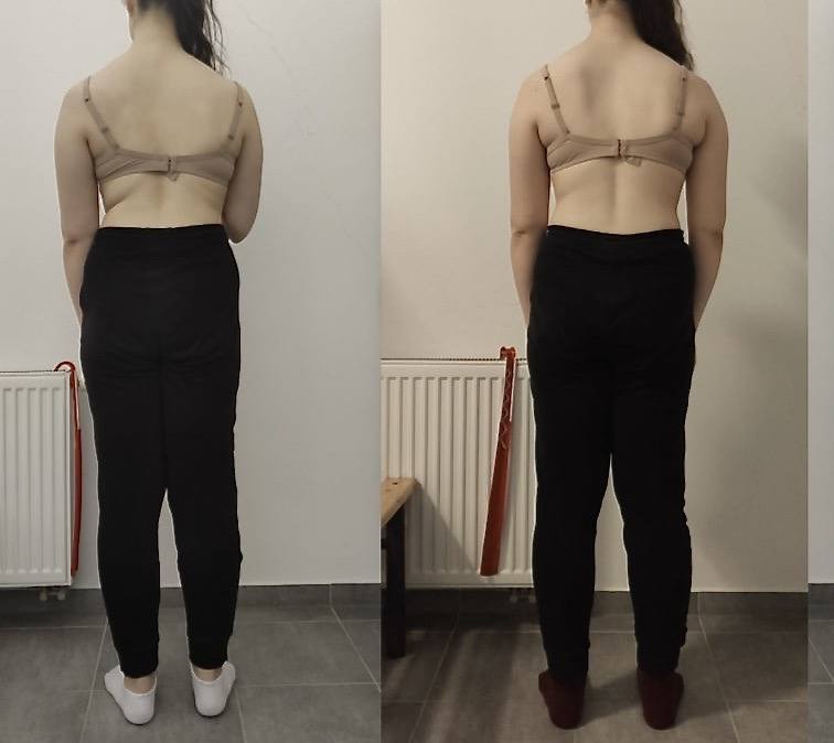 Dvě fotografie zad ženy ve stoji, pohled zezadu, hodnocení držení těla